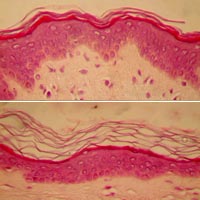 cutaneous desquamation
