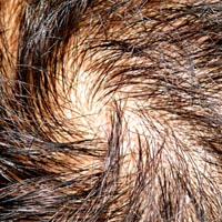 re-growth and proliferation of hair�