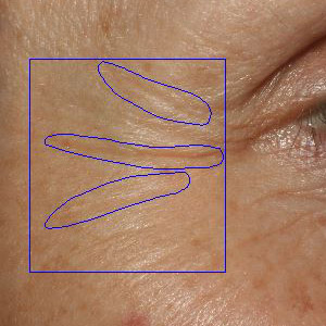 Dermatological evaluation of wrinkle depth and fine lines ...